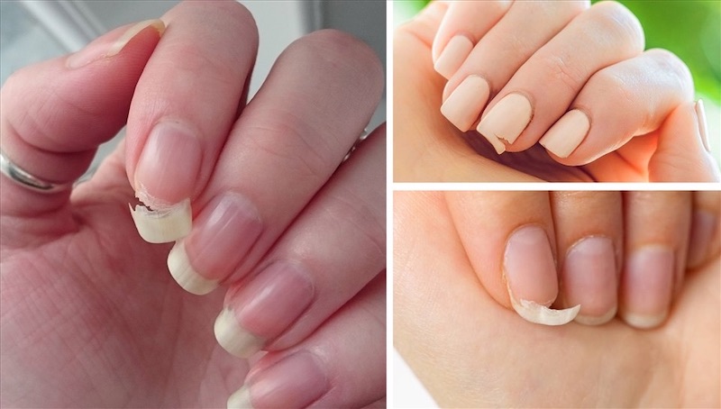 Hiện tượng móng tay dễ bị gãy cảnh báo cơ thể có nhiều nguy cơ bị thiếu chất