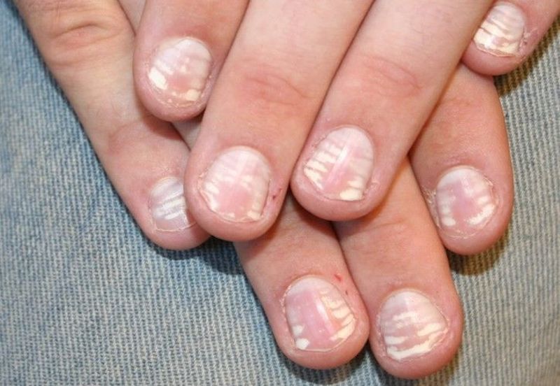 Các đốm trắng rải rác trên móng nhiều cảnh báo có thể bạn bị mắc bệnh về thận hoặc thiếu chất