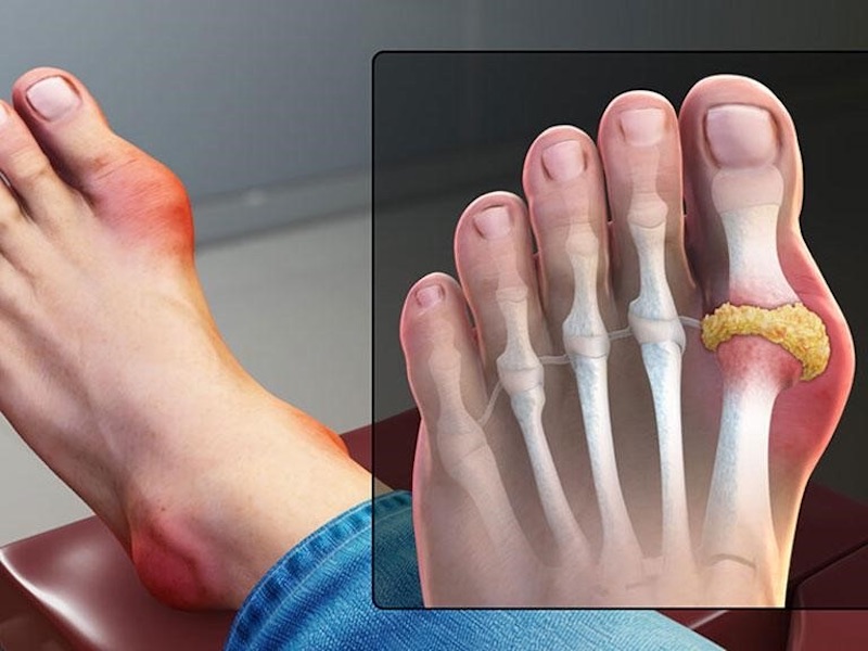 Cải thiện đáng kể cơn đau do bệnh gút gây ra nhờ quả anh đào
