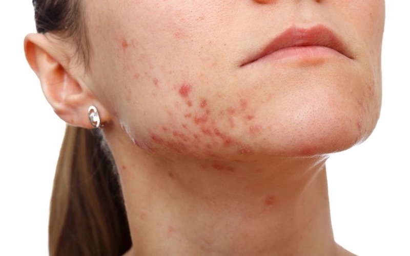 Vải nhiều đường dễ gây nóng trong