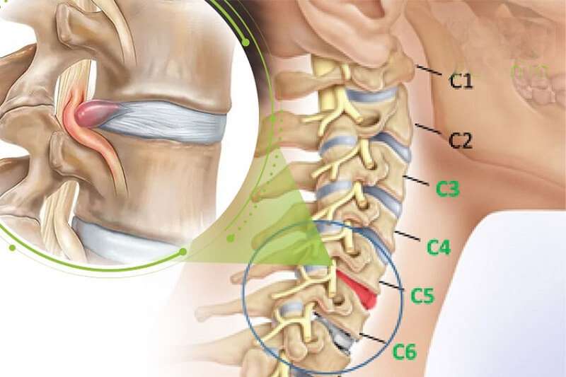 Bệnh lý thoát vị đĩa đệm cổ gây ra nhiều bất tiện cho người mắc