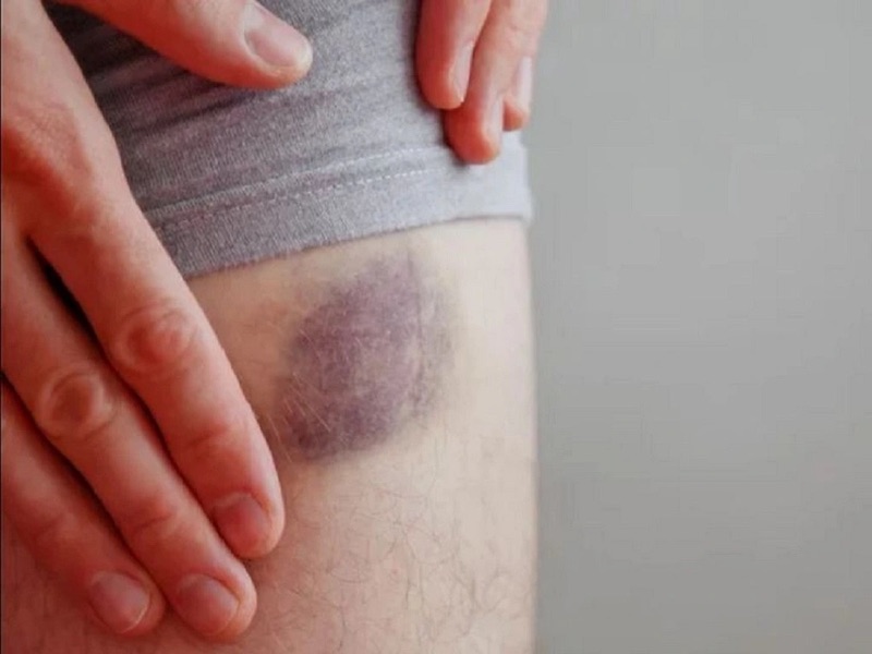 Massage trực tiếp lên vùng bị bầm có thể làm tăng nguy cơ chảy máu