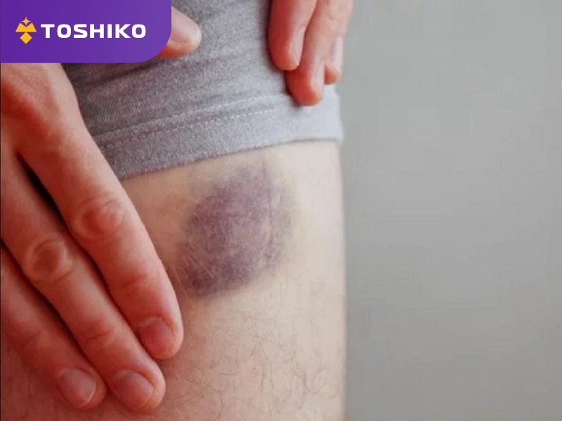 Bị bầm tím có nên dùng ghế massage không?