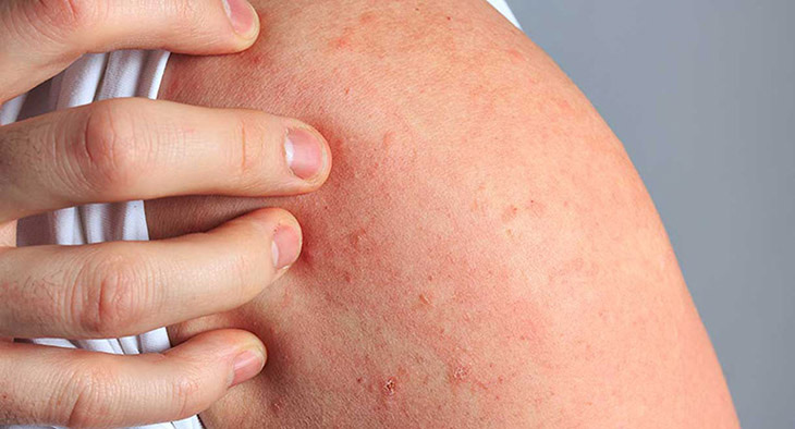 Có thể gây ra hiện tượng dị ứng