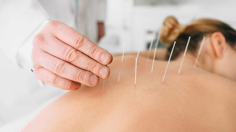 Châm cứu là phương pháp trị liệu đau mỏi theo hướng cổ truyền