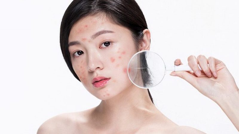 Không nên để dầu dừa ứ đọng trên da vì có thể gây mụn