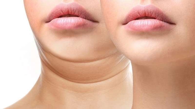 Ngấn mỡ cổ dày khiến dáng cằm bị ảnh hưởng