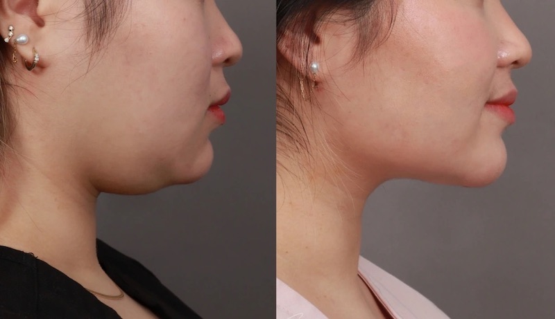 Can thiệp phẫu thuật để loại bỏ mỡ thừa và căng da cổ