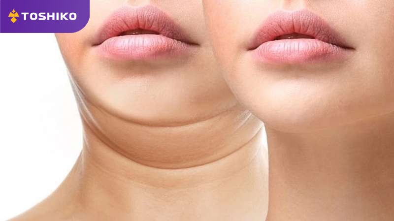 Cách giảm mỡ cổ, hết ngấn cổ nhanh và hiệu quả ngay tại nhà