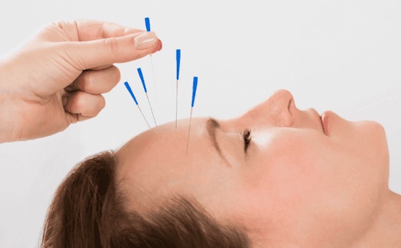 Châm cứu sẽ giúp xoa dịu chứng đau đầu