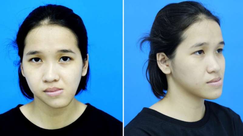 Mặt lệch do cấu trúc xương hàm