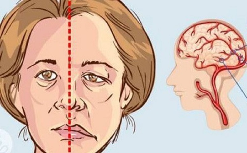 Liệt dây thần kinh khiến mặt bị lệch