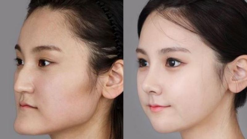 Lựa chọn phương pháp phù hợp dựa trên từng cấu trúc gương mặt