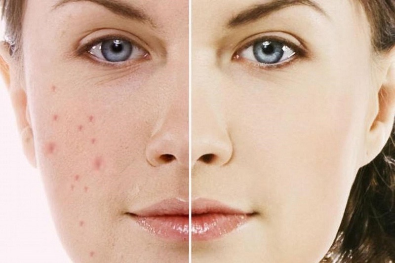 Massage giúp xóa mờ nếp nhăn và giảm mụn
