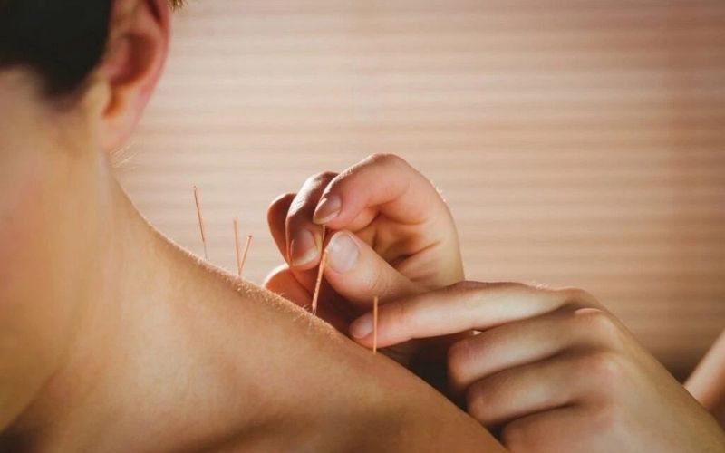 Châm cứu được áp dụng nhiều trong trị liệu