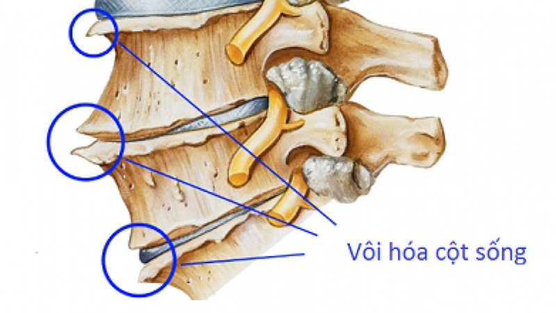 Đau cổ vai gáy có thể là biểu hiện của bệnh vôi hóa cột sống
