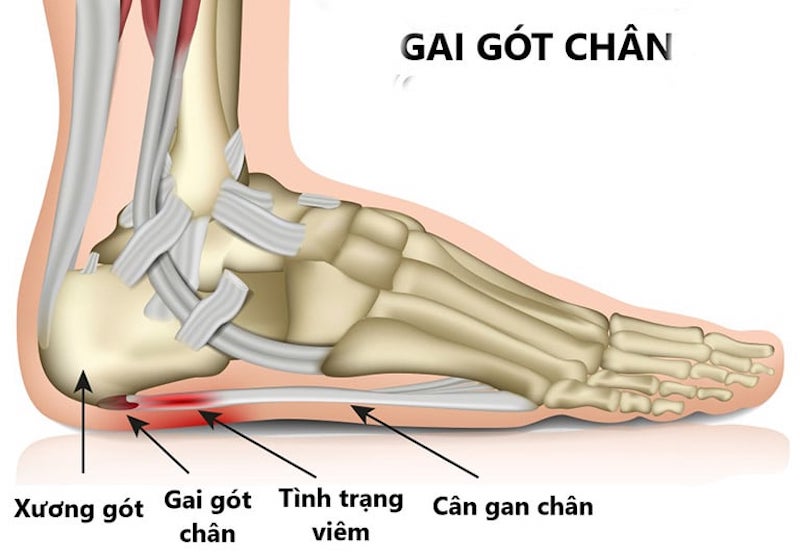 Gai gót chân gây cọ xát với mô mềm làm nặng hơn tình trạng đau gót