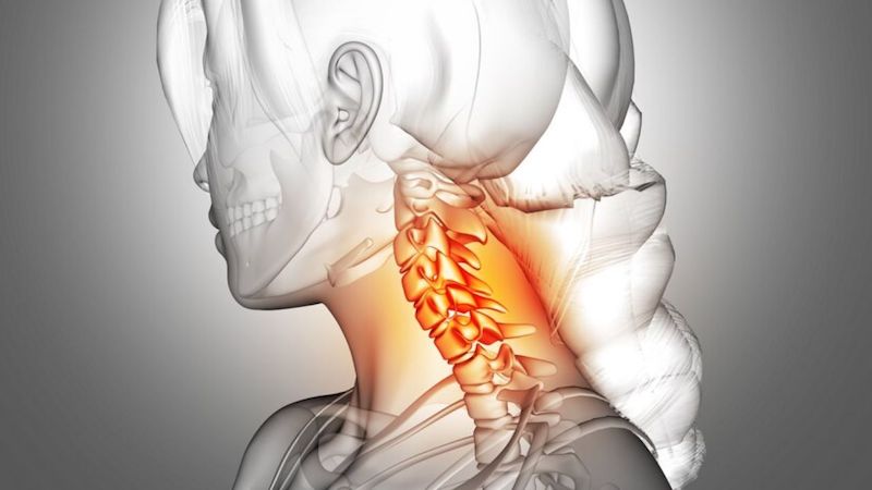 Hẹp ống sống cổ cũng có thể gây đau vai gáy