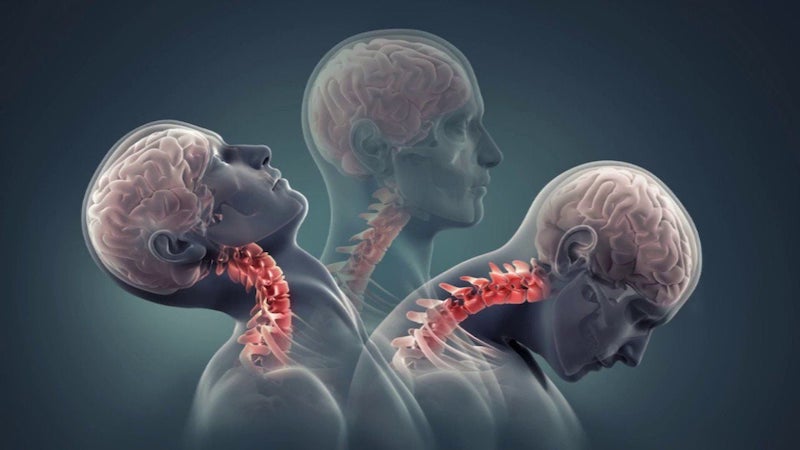 Thoái hóa đốt sống cổ với biểu hiện là đau mỏi vai gáy