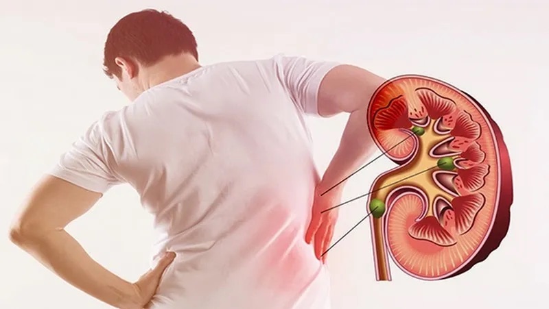 Người bị sỏi thận nên khống chế lượng đu đủ cho mỗi khẩu phần