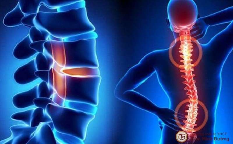 Bệnh lý cong vẹo cột sống cần được tư vấn chuyên sâu về cách chữa trị