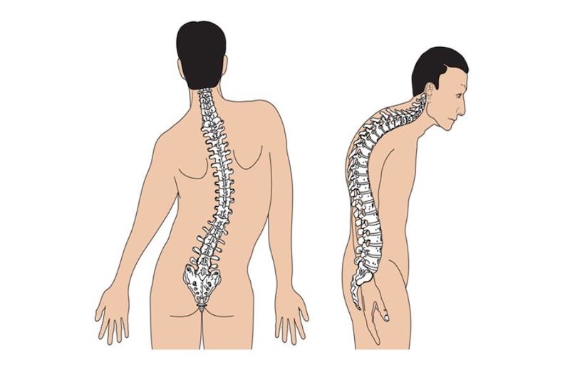 Vẹo cột sống là tình trạng cột sống bị cong hoặc lệch bất thường