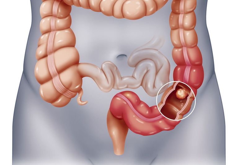 Ăn quá nhiều hạt lựu có thể gây tắc ruột