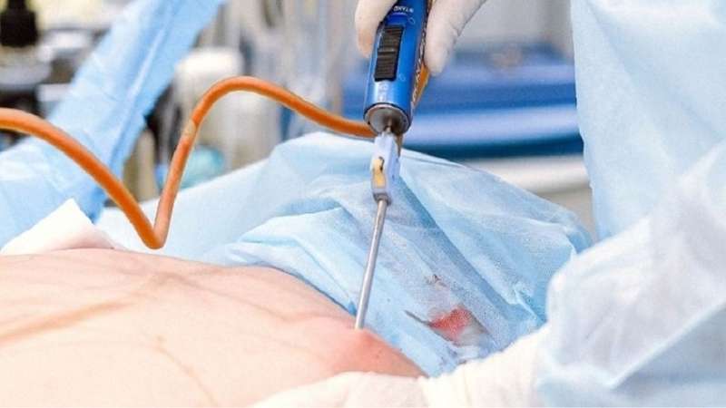 Can thiệp bằng các biện pháp chuyên sâu như hút mỡ nách hay phẫu thuật cho hiệu quả nhanh