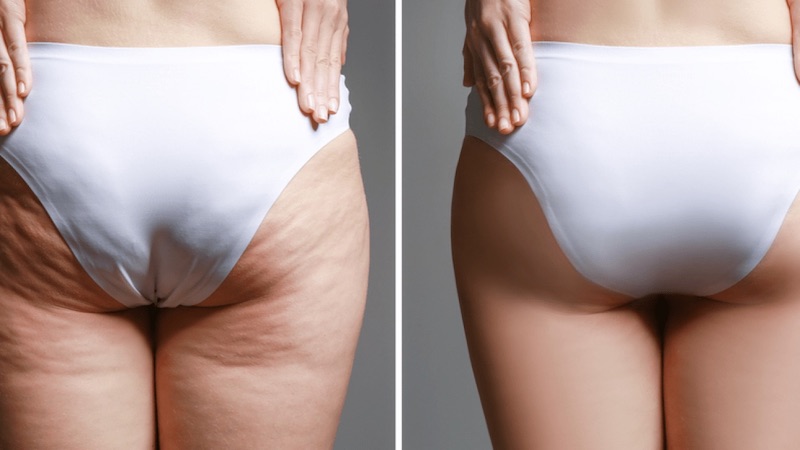 Mông bị chảy xệ