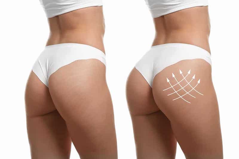 Nâng mông thẩm mỹ để cải thiện vòng 3