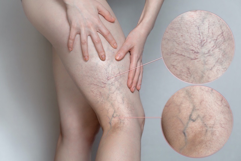 Người bị suy giãn tĩnh mạch cần cẩn trọng khi sử dụng ghế massage
