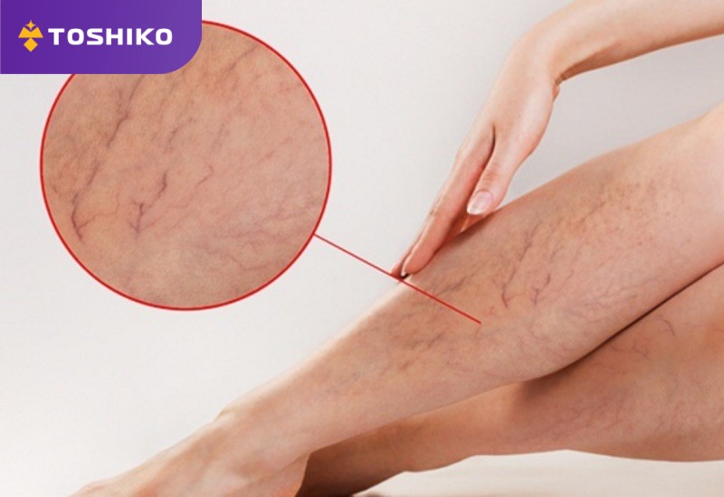 Người suy giãn tĩnh mạch có nên ngồi ghế massage không?