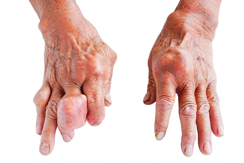 Nguyên nhân dẫn đến bệnh gout