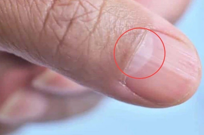 Móng có hình bán nguyệt lớn ảnh báo chức năng gan có vấn đề