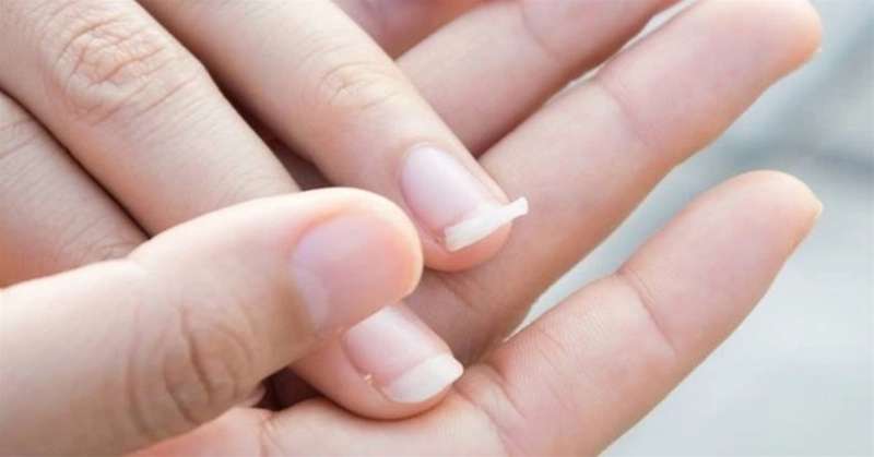 Móng dễ bị gãy là cảnh báo của hiện tượng thiếu hụt biotin