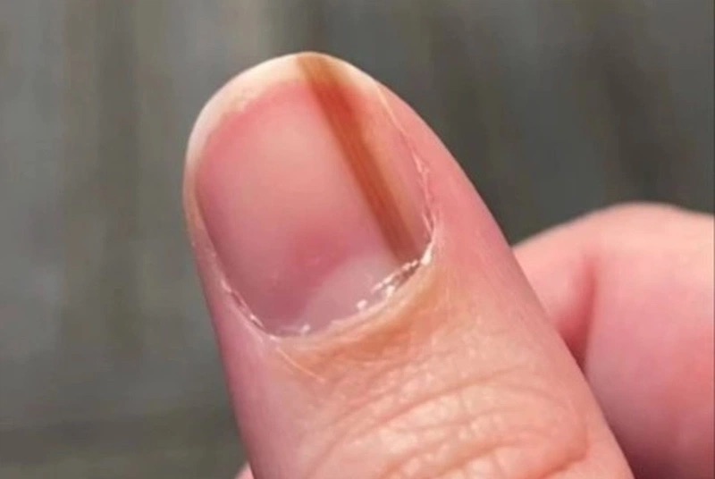 Móng tay có sọc đỏ