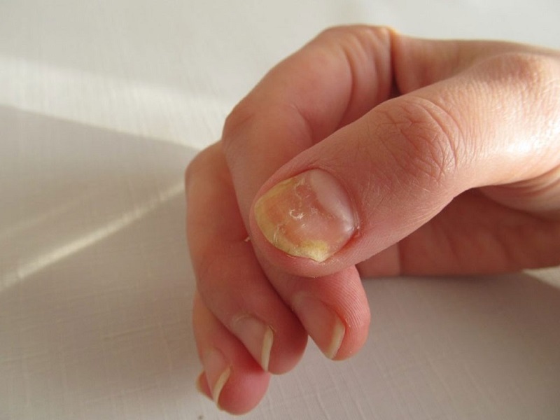 Móng tay chân bị lõm cảnh báo nhiều vấn đề về sức khỏe