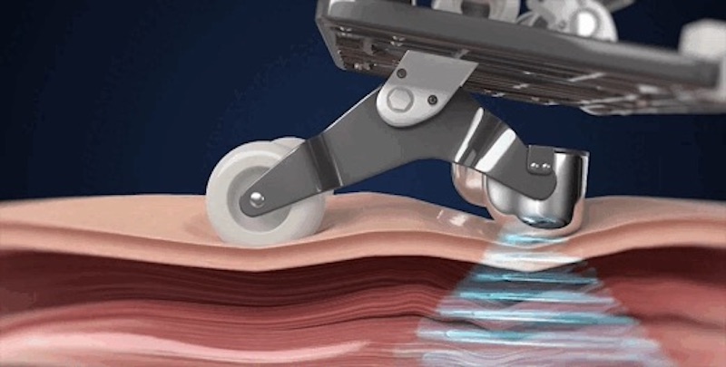 Sóng âm thúc đẩy quá trình phục hồi vi mô diễn ra hiệu quả hơn