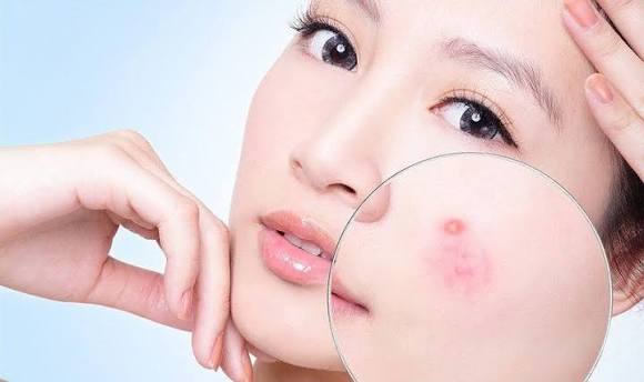 Giảm mụn nhờ vỏ lựu