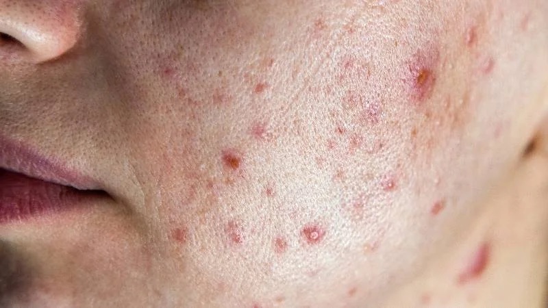 Matxa với dầu oliu mà không vệ sinh kỹ có thể gây mụn