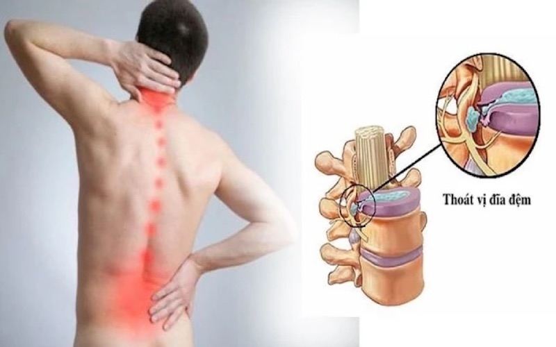 Các bệnh lý về cột sống có thể khiến cơn đau mỏi trở nên nghiêm trọng hơn