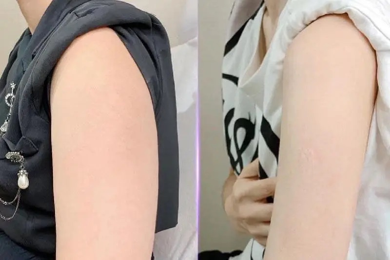 Tiêm botox giúp làm thon gọn bắp tay