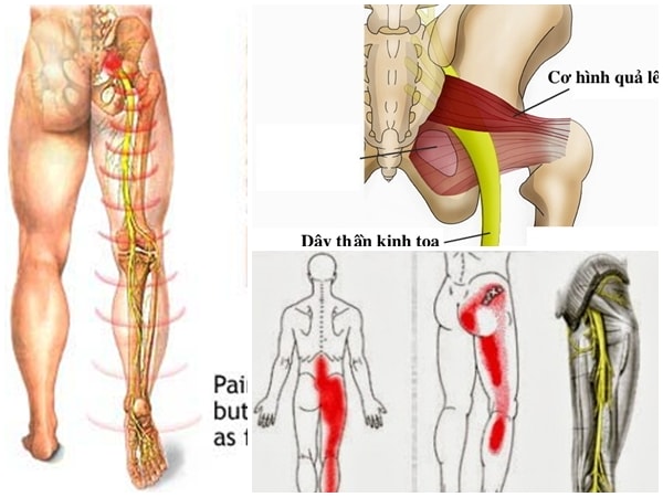Đau dây thần kinh tọa - Nỗi lo lắng của nhiều người