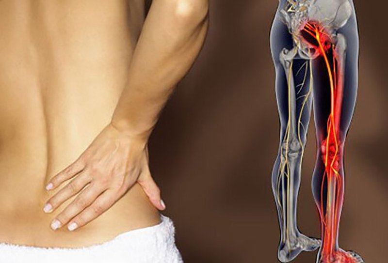 Đau dây thần kinh tọa ảnh hưởng đến sinh hoạt hàng ngày