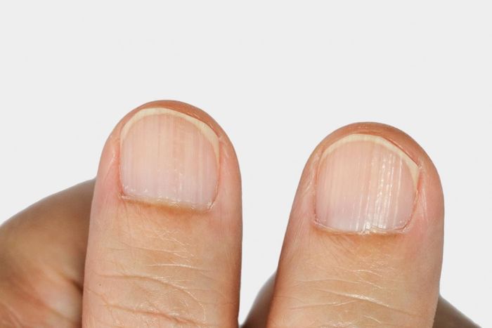 Móng tay chân có nhiều sọc nổi