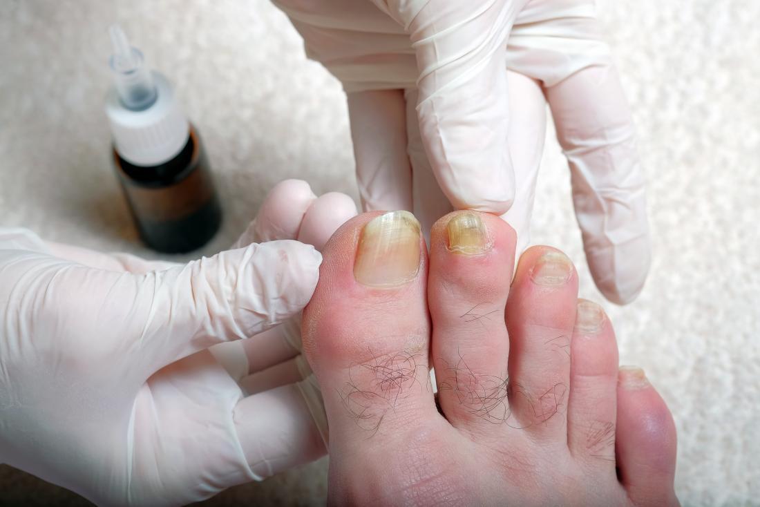 Móng thay đổi màu bất thường cảnh báo nhiều bệnh lý nguy hiểm