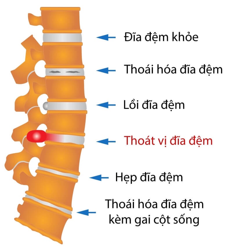 Thoát vị đĩa đệm do nhiều nguyên nhân khác nhau gây nên