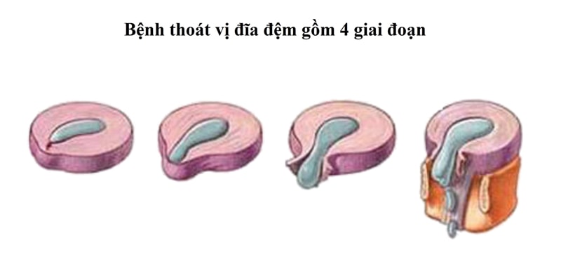 Thoát vị đĩa đệm trải qua 4 giai đoạn khác nhau