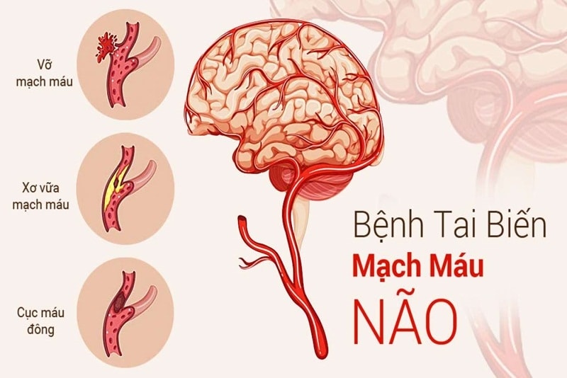 Tai biến mạch máu não còn được gọi là đột quỵ
