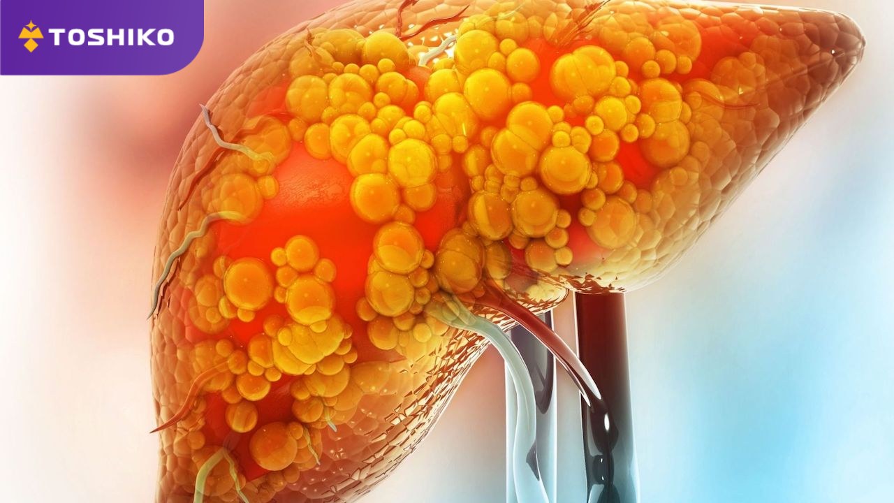 Gan nhiễm mỡ có nên tập máy chạy bộ? Hướng dẫn tập an toàn